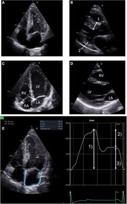 Impact of enzyme replacement therapy and migalastat on left atrial strain and cardiomyopathy in patients with Fabry disease